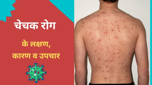 chechak-chicken-pox-in-hindi-lakshan-types-causes-symptoms